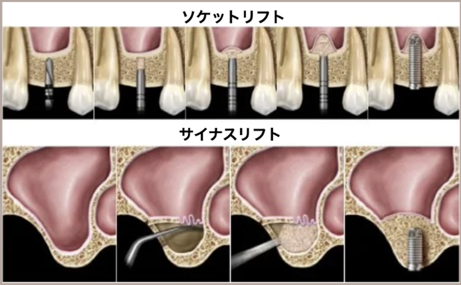 サイナスリフトの症例