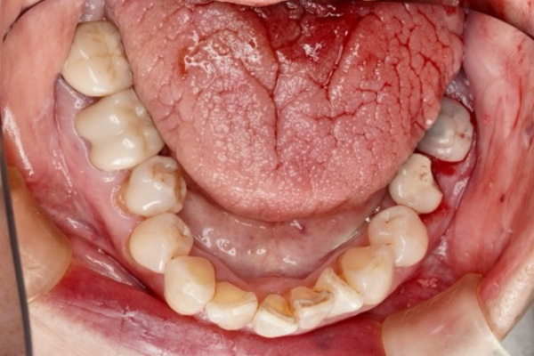 歯根破折からの回復症例