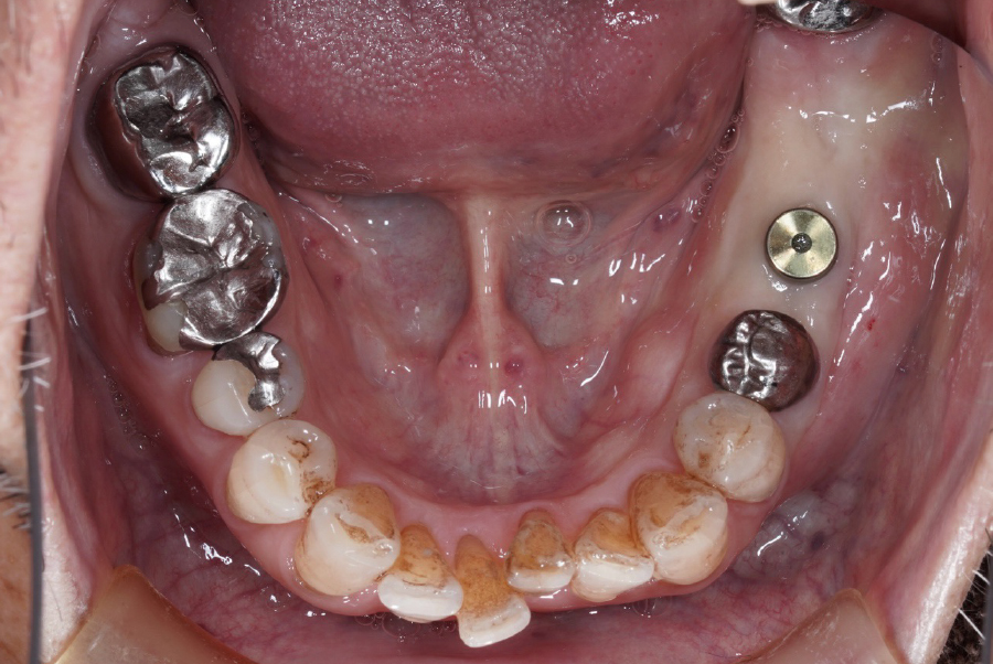 歯槽堤温存術の症例