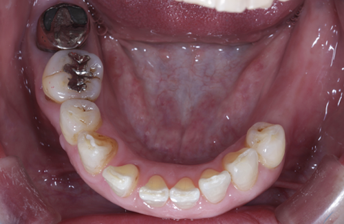 矯正治療の症例5-1