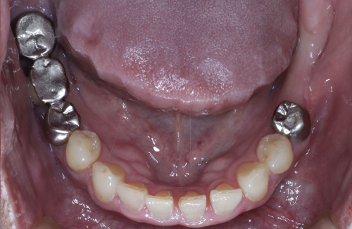 矯正治療の症例5-1