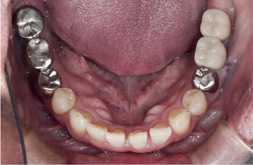 矯正治療の症例5-2