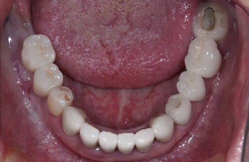 矯正治療の症例5-2