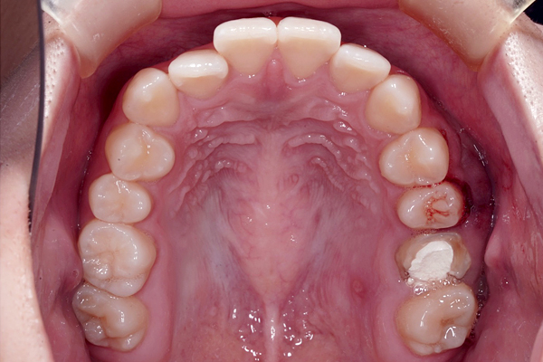 歯槽堤温存術の症例