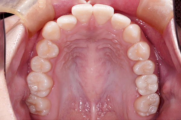 歯槽堤温存術の症例