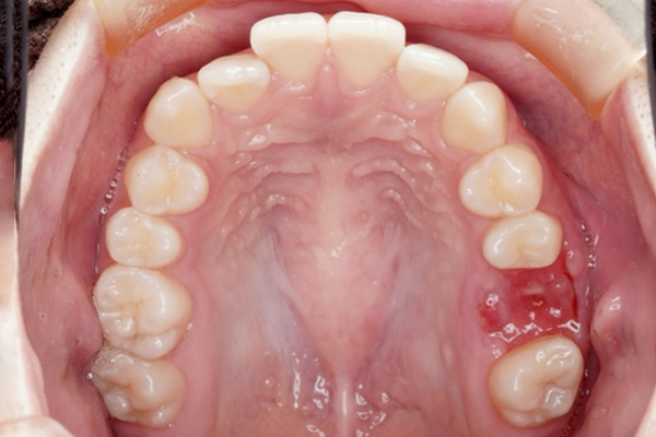 歯槽堤温存術の症例