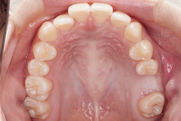 歯槽堤温存術の症例
